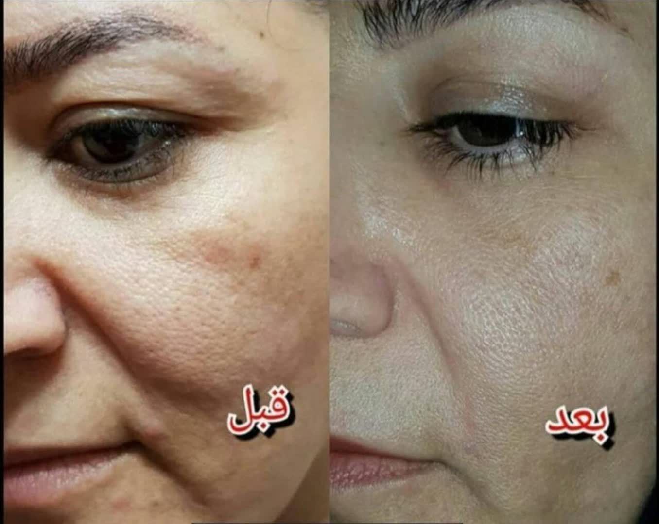 نتیجه درمان پوست مختلط